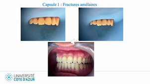 1. Fractures amélaires_VM DIU LMNOP26.mp4