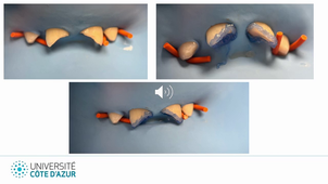 2. Fractures amélo-dentiaires sans exposition pulpaire_VM DIU LMNOP26.mp4