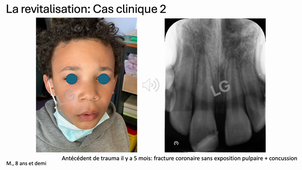 3 Apexification Revitalisation_Goupy AEU26