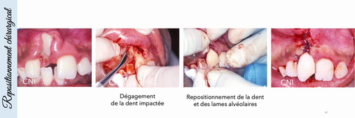 Caspule 2. Impaction_EADIU LMNOP26.mp4