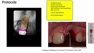 2 Complications des Expulsions_LG AEU26.mp4