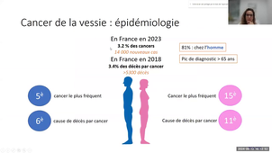 20240912 Bases fondamentales de l'oncogénèse - Oncogènes et gènes suppresseurs de tumeur - Développement tumoral de la tumeur bénigne:polype au cancer, ex de la vessie.mp4