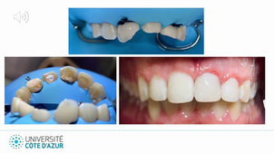 3. Fractures amélo-dentinaires avec exposition pulpaire_VM DIU LMNOP26.mp4