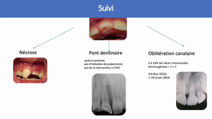 3. Facteurs de survie pulpaire et réhabilitation_EN AEU26.mp4